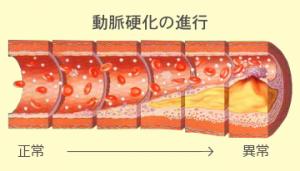 動脈硬化のイメージ