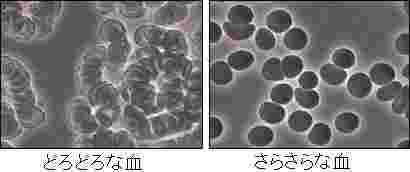 サラサラ血液とドロドロ血液