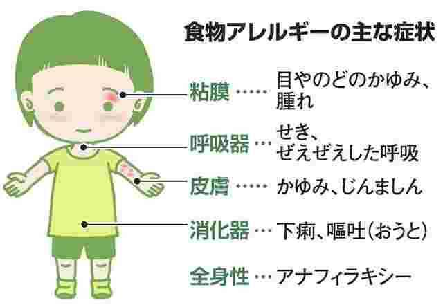 食物アレルギーの症状