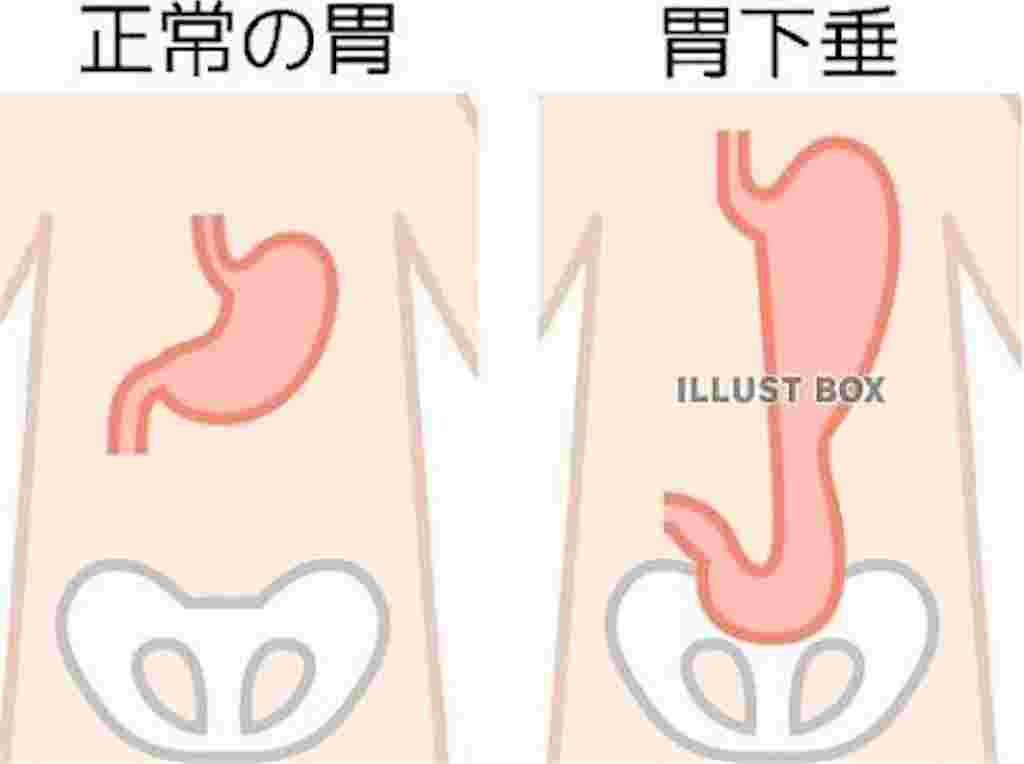 胃下垂の図