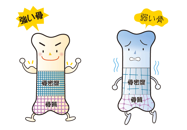 健康な骨と骨粗しょう症の骨