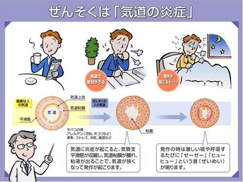 気管支喘息が起こる仕組み