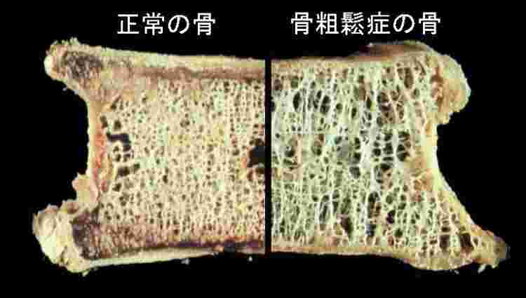 正常な骨と骨粗鬆症の骨の断面