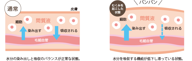 むくみのしくみがわかるイラスト