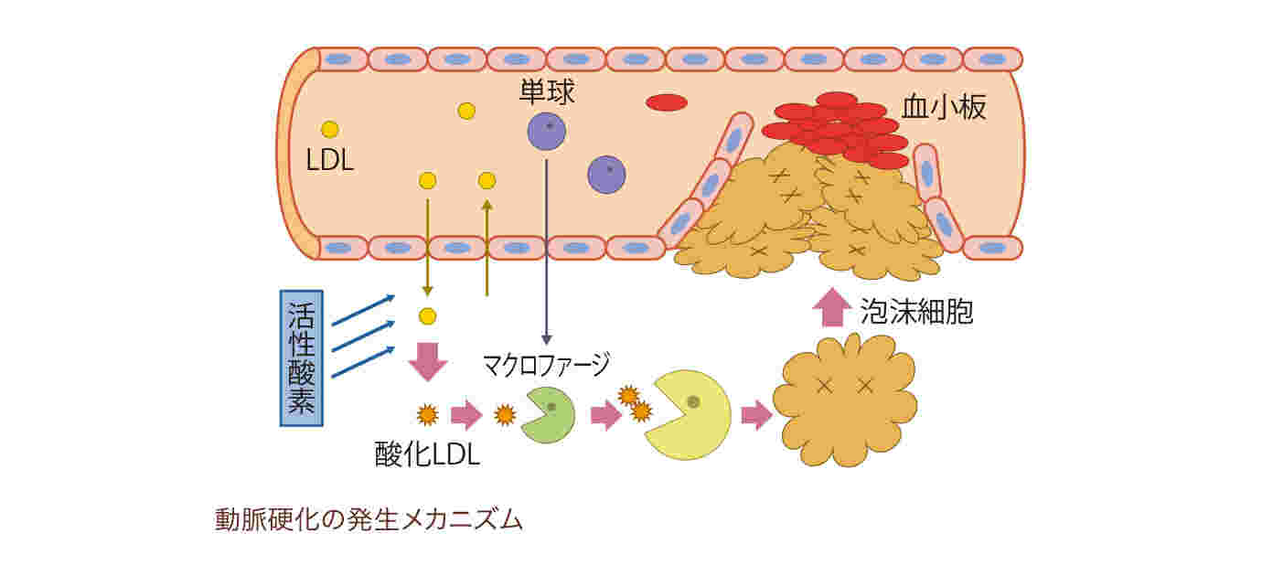 動脈硬化のイラスト