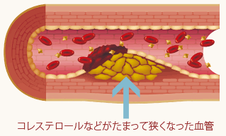 動脈硬化のイメージイラスト
